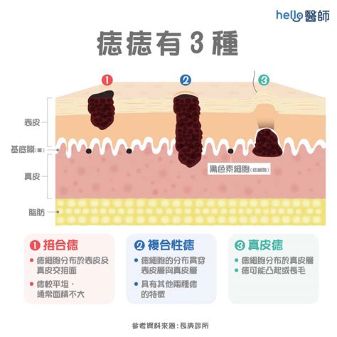 痣長毛原因|痣形成的原因？痣長毛、痣變多變大是痣病變？5。